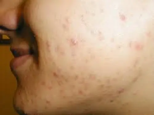 Come scegliere l’alimentazione per chi è affetto da acne inversa