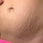 Smagliature : quello che non sapevate